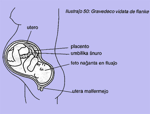 Gravedeco vidata de flanke