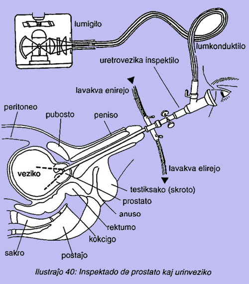 Inspektado de prostato kaj urinveziko